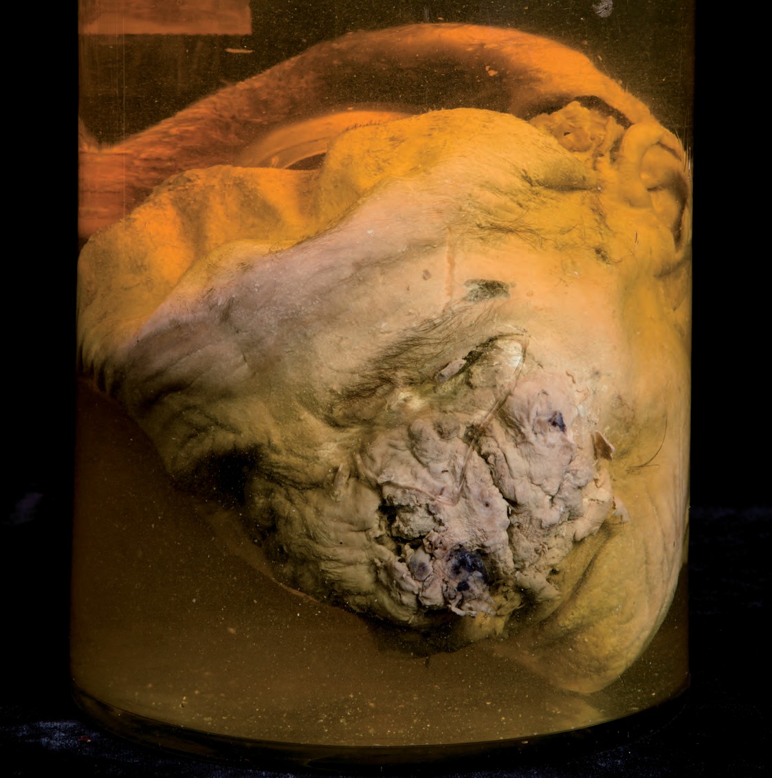 singolo reperto antropologico, preparato anatomico (morfologia alterata per patologia) (XIX-XX)