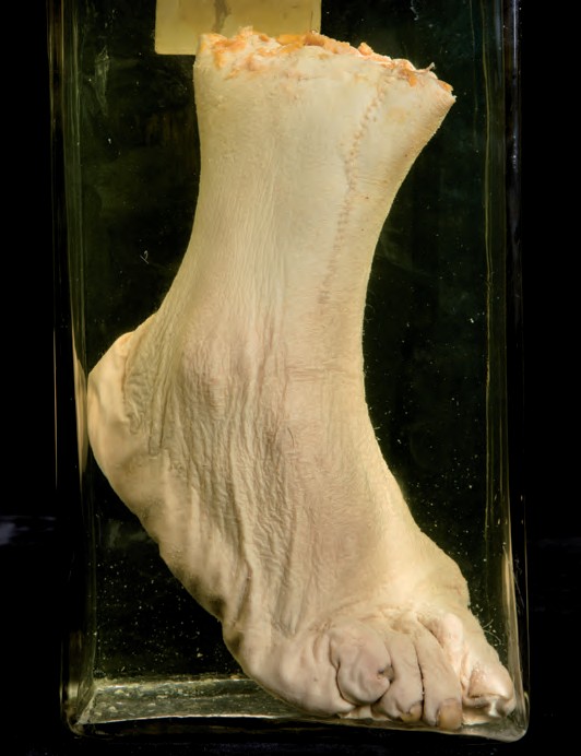 singolo reperto antropologico, preparato anatomico (morfologia alterata per patologia) (XIX-XX)