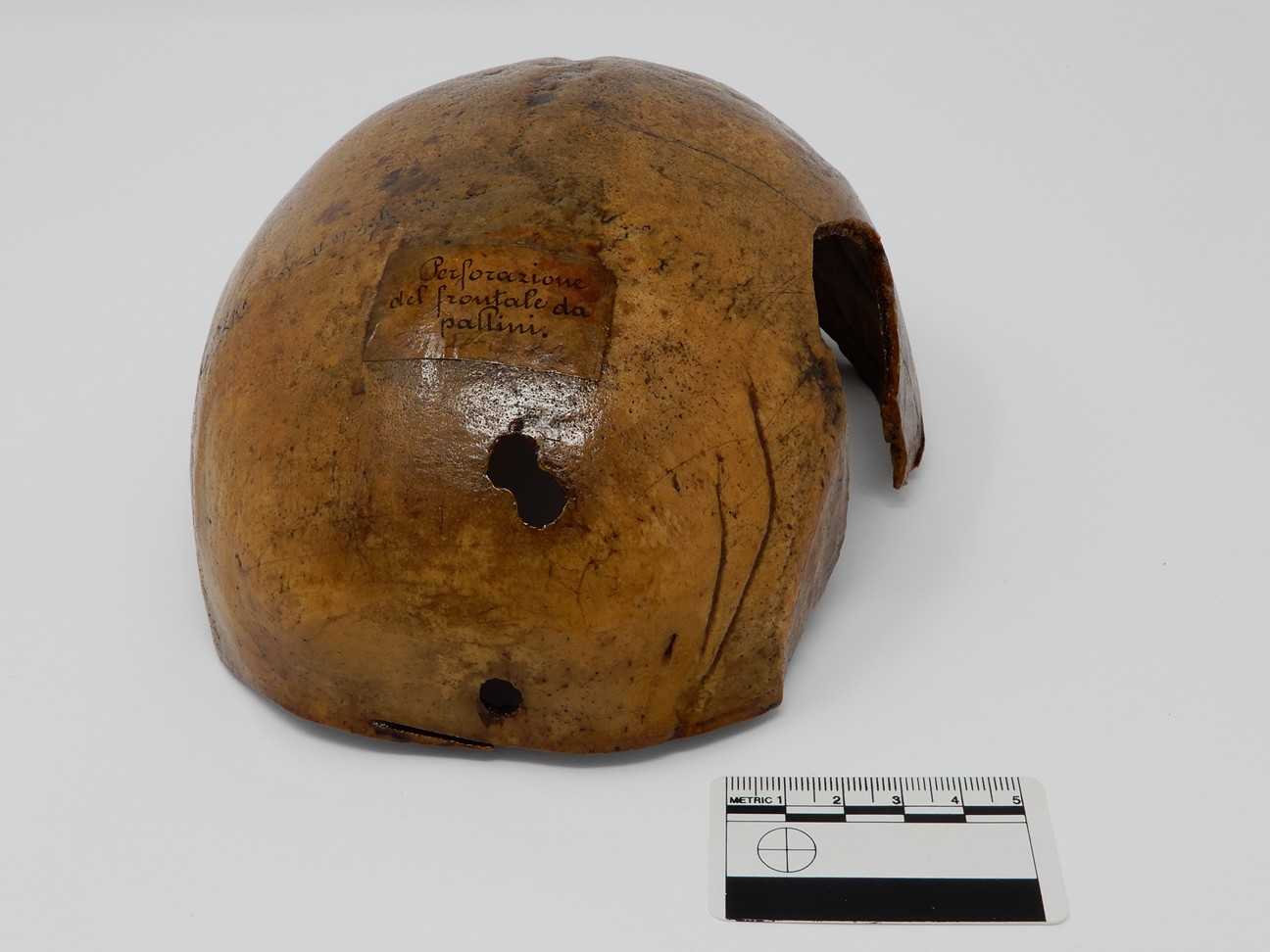 singolo reperto antropologico, reperto osseo (morfologia alterata per patologia) (XIX-XX)