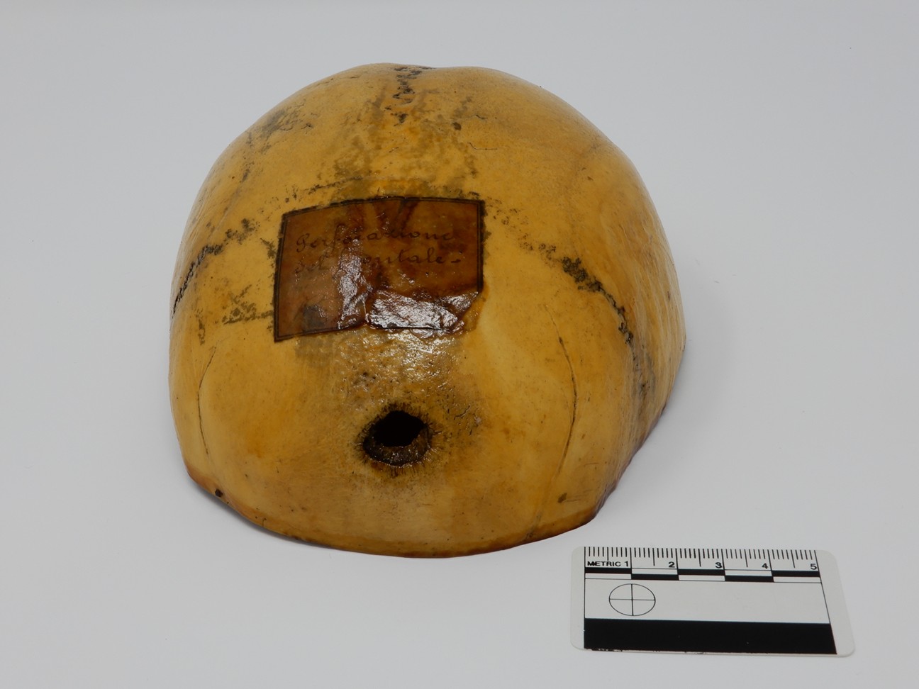 singolo reperto antropologico, reperto osseo (morfologia alterata per patologia) (XIX-XX)