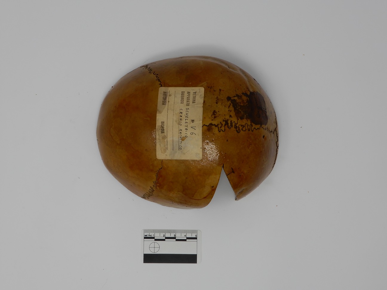 singolo reperto antropologico, reperto osseo (morfologia alterata per patologia) (XIX-XX)