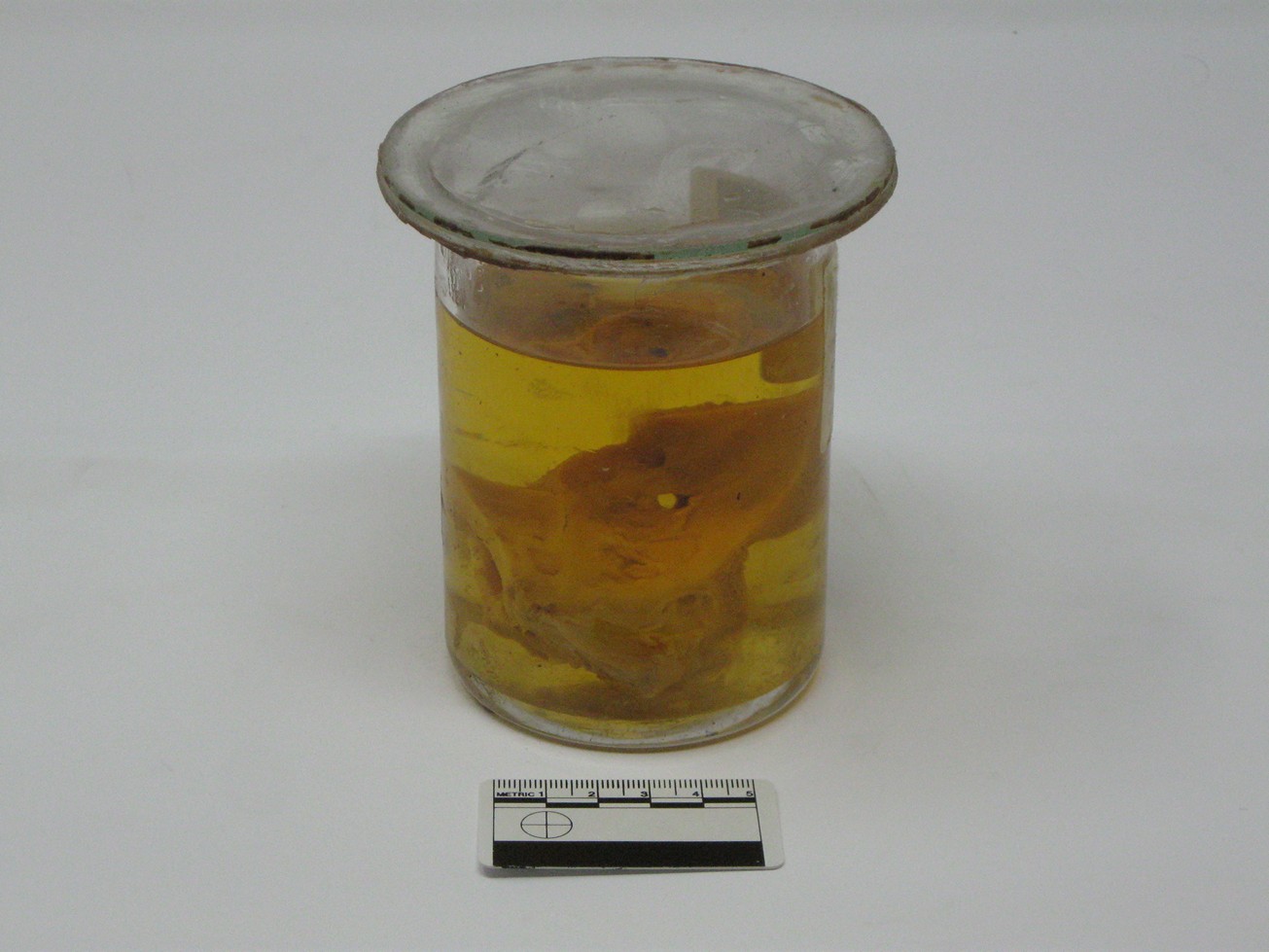 singolo reperto antropologico, reperto osseo (morfologia alterata per patologia) (XIX-XX)