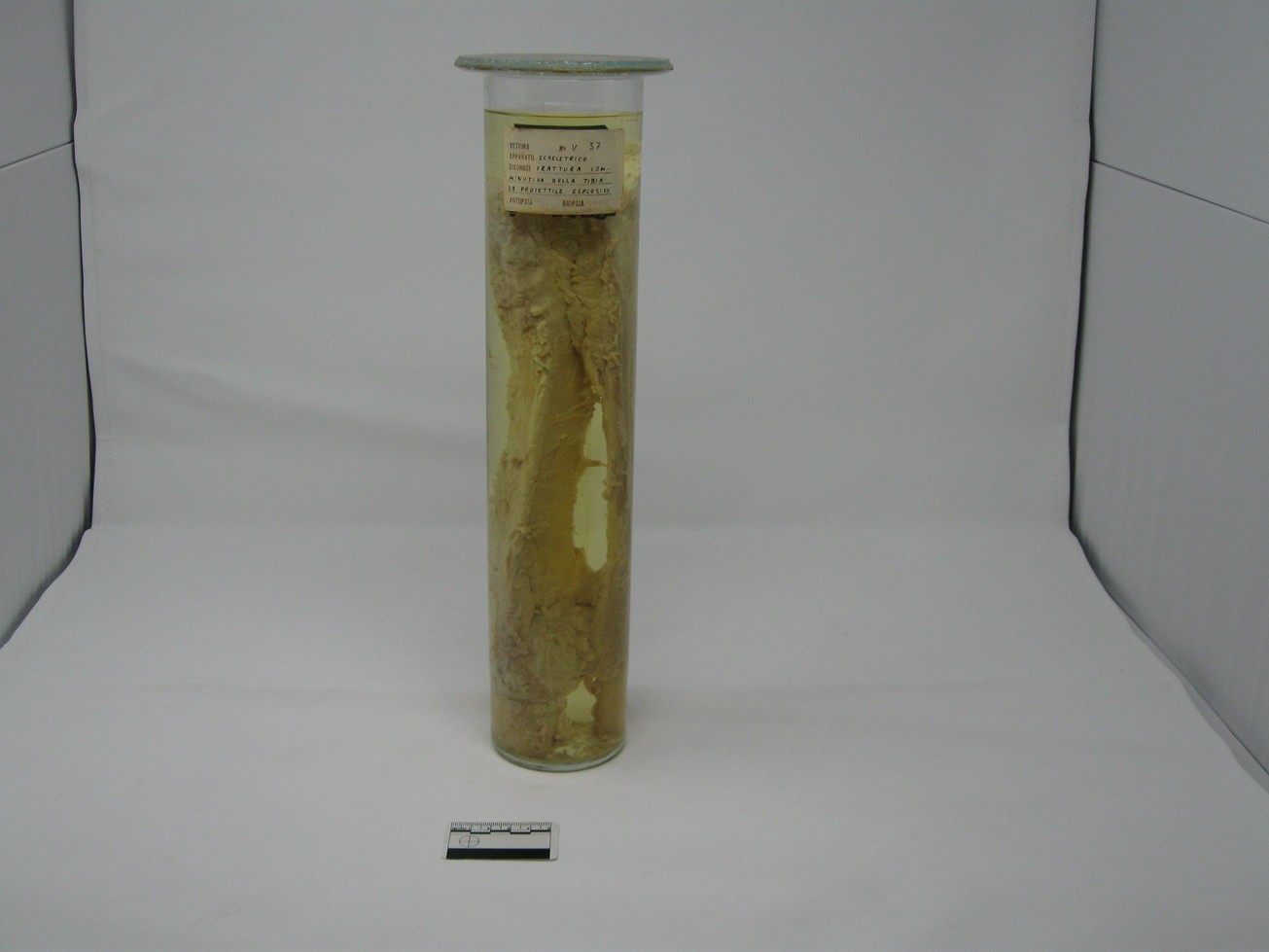 singolo reperto antropologico, reperto osseo (morfologia alterata per patologia) (XIX-XX)