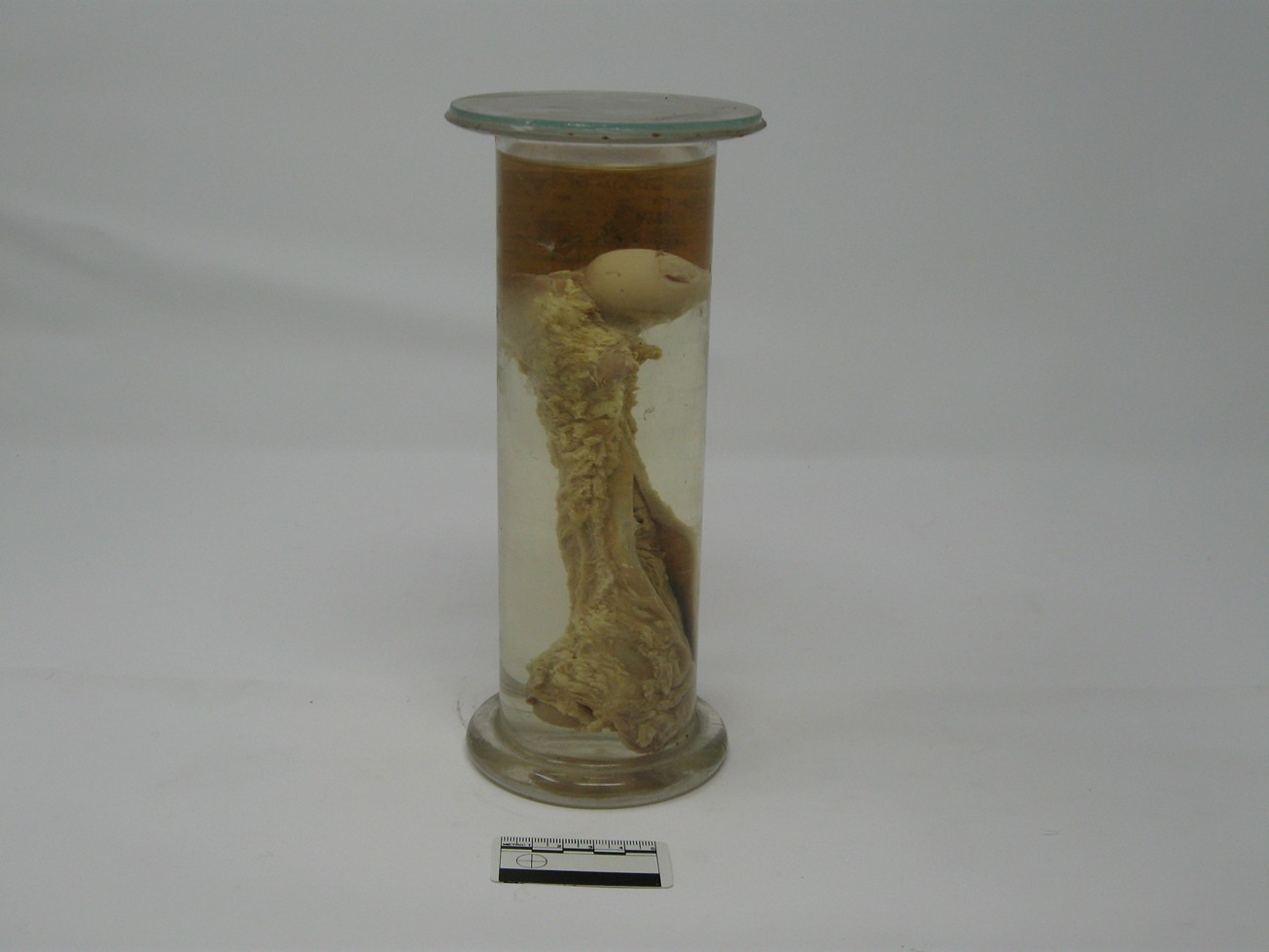 singolo reperto antropologico, reperto osseo (morfologia alterata per patologia) (XIX-XX)