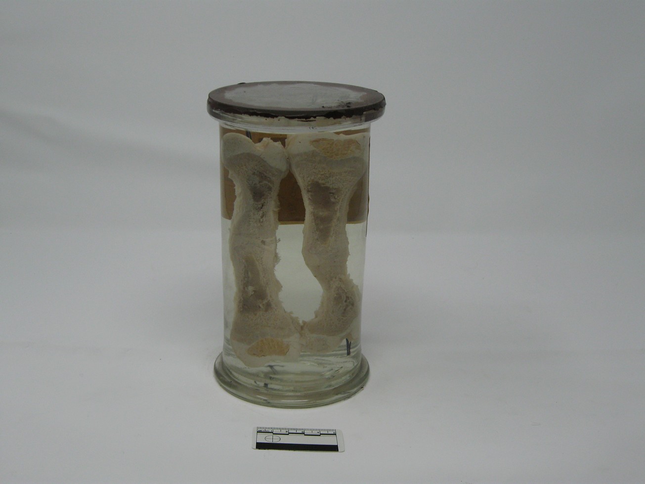 singolo reperto antropologico, reperto osseo (morfologia alterata per patologia) (XIX-XX)