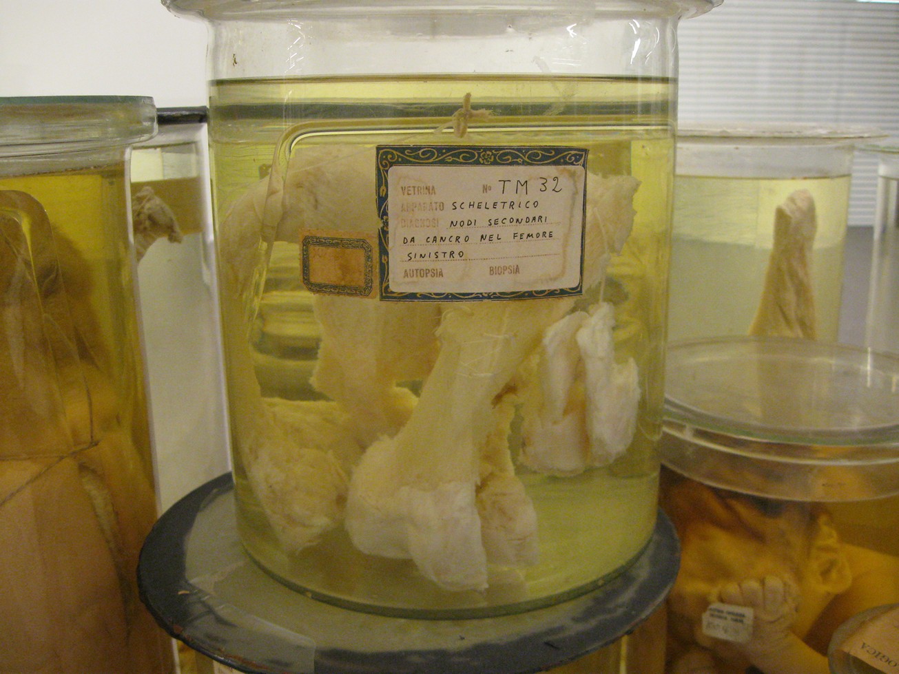 singolo reperto antropologico, reperto osseo (morfologia alterata per patologia) (XIX-XX)