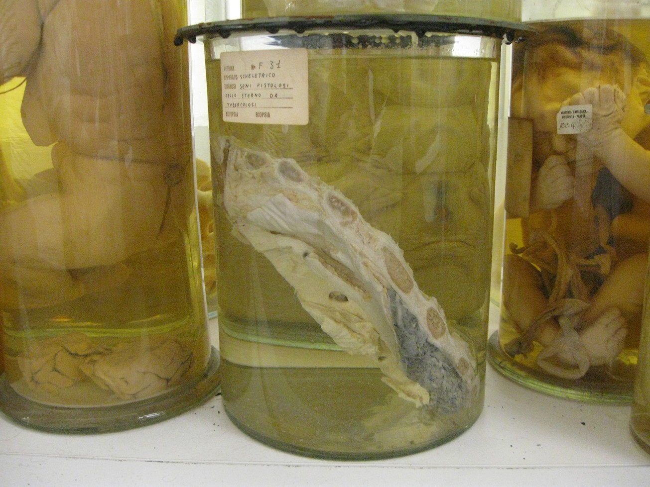 singolo reperto antropologico, reperto osseo (morfologia alterata per patologia) (XIX-XX)