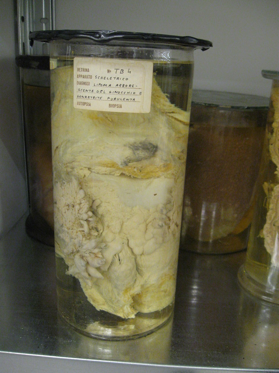 singolo reperto antropologico, reperto osseo (morfologia alterata per patologia) (XIX-XX)