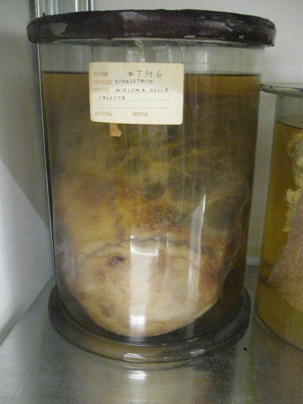 singolo reperto antropologico, reperto osseo (morfologia alterata per patologia) (XIX-XX)