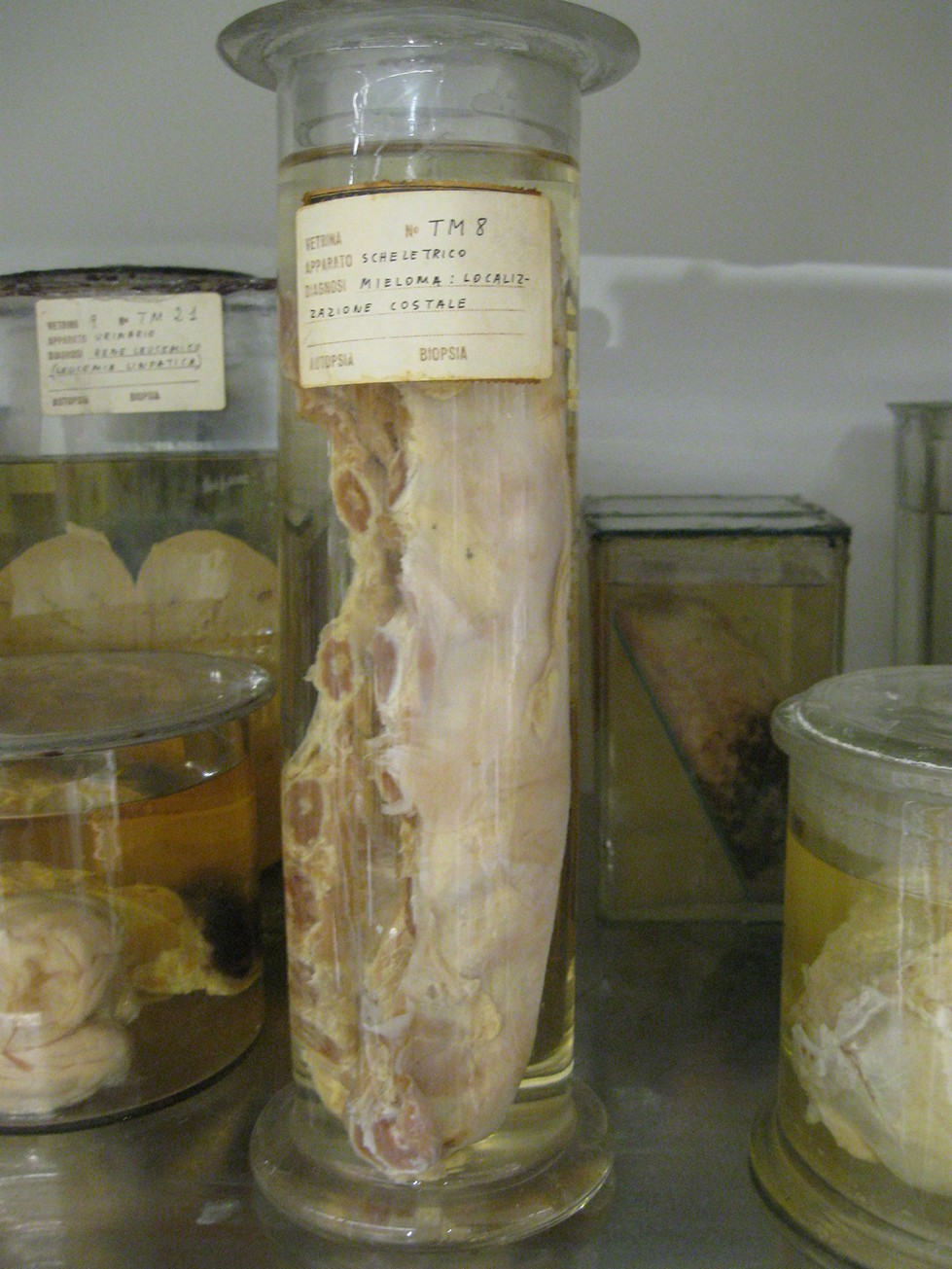 singolo reperto antropologico, reperto osseo (morfologia alterata per patologia) (XIX-XX)