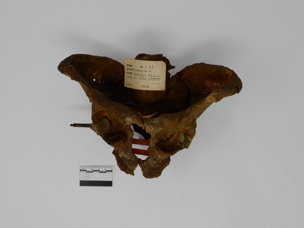 singolo reperto antropologico, reperto osseo (morfologia alterata per patologia) (XIX-XX)