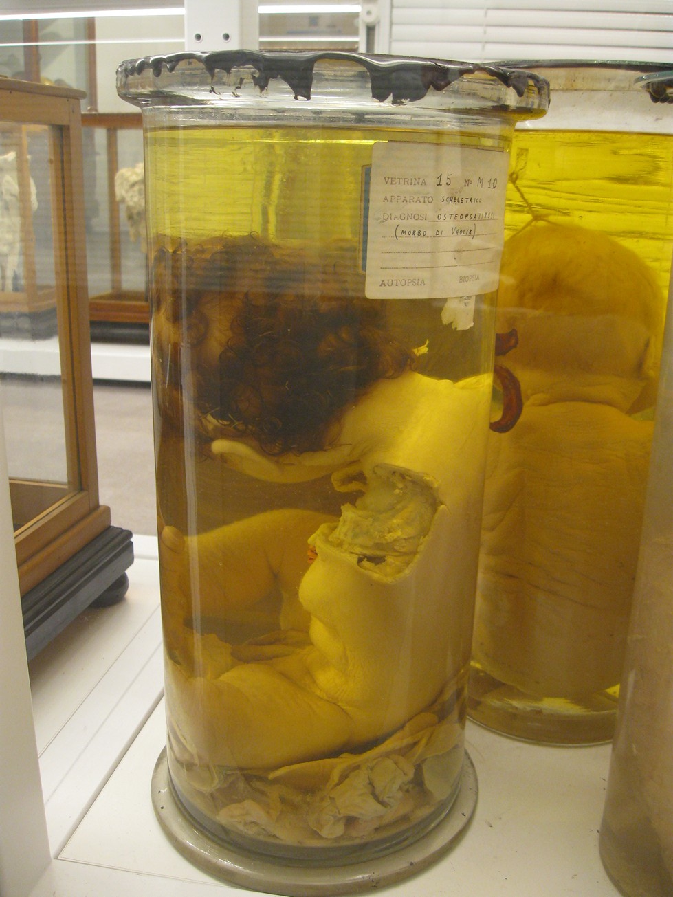 singolo reperto antropologico, reperto osseo (morfologia alterata per patologia) (XIX-XX)