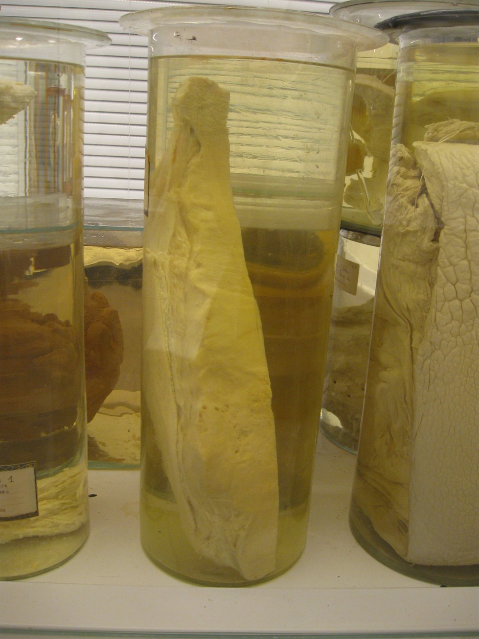 singolo reperto antropologico, reperto osseo (morfologia alterata per patologia) (XIX-XX)