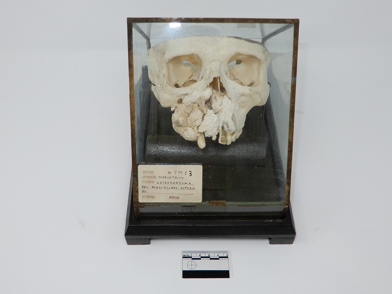 singolo reperto antropologico, reperto osseo (morfologia alterata per patologia) (XIX-XX)