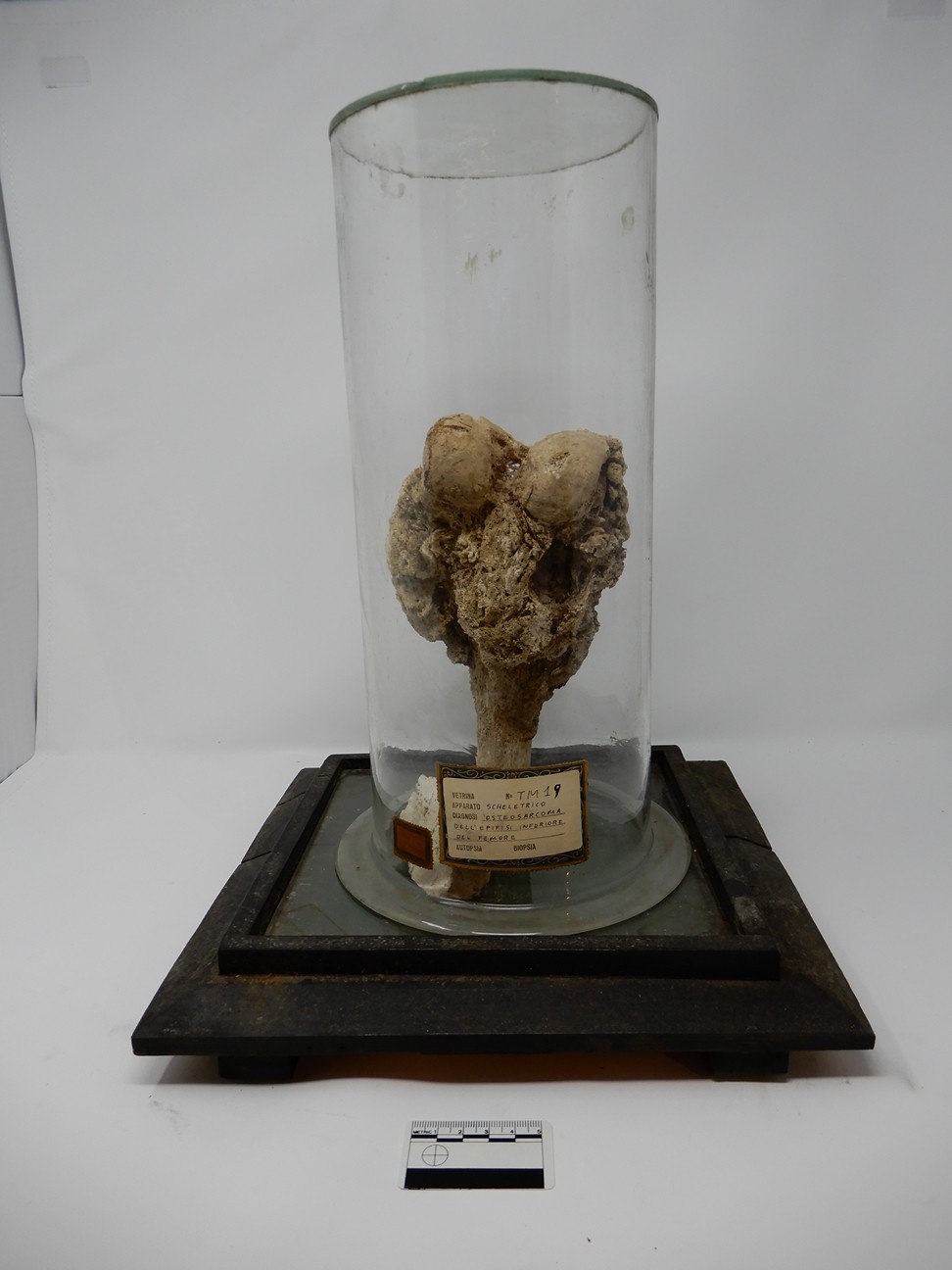 singolo reperto antropologico, reperto osseo (morfologia alterata per patologia) (XIX-XX)