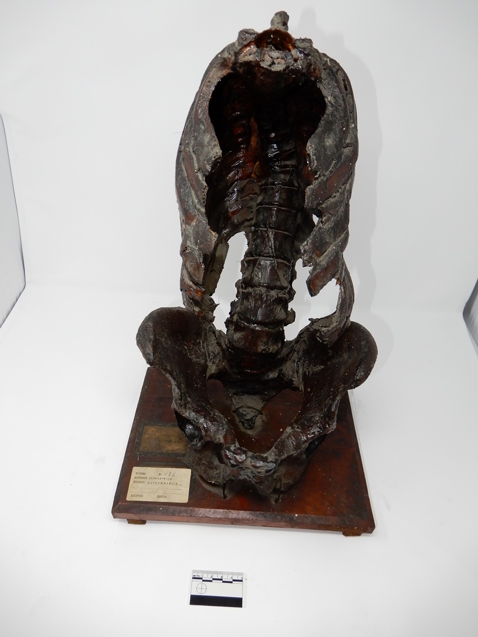 singolo reperto antropologico, reperto osseo (morfologia alterata per patologia) (XIX-XX)