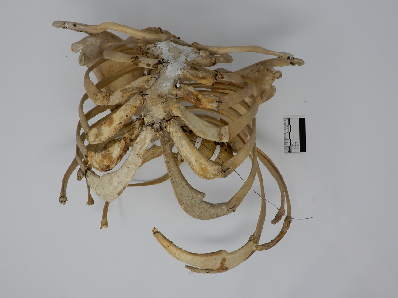 singolo reperto antropologico, reperto osseo (morfologia alterata per patologia) (XIX-XX)