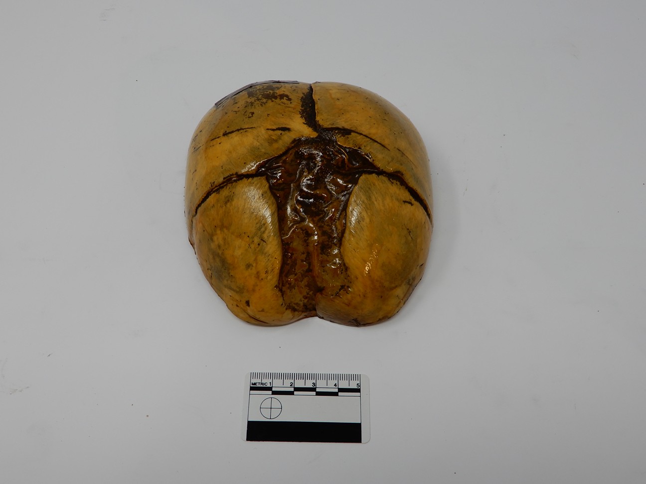 singolo reperto antropologico, reperto osseo (morfologia alterata per patologia) (XIX-XX)