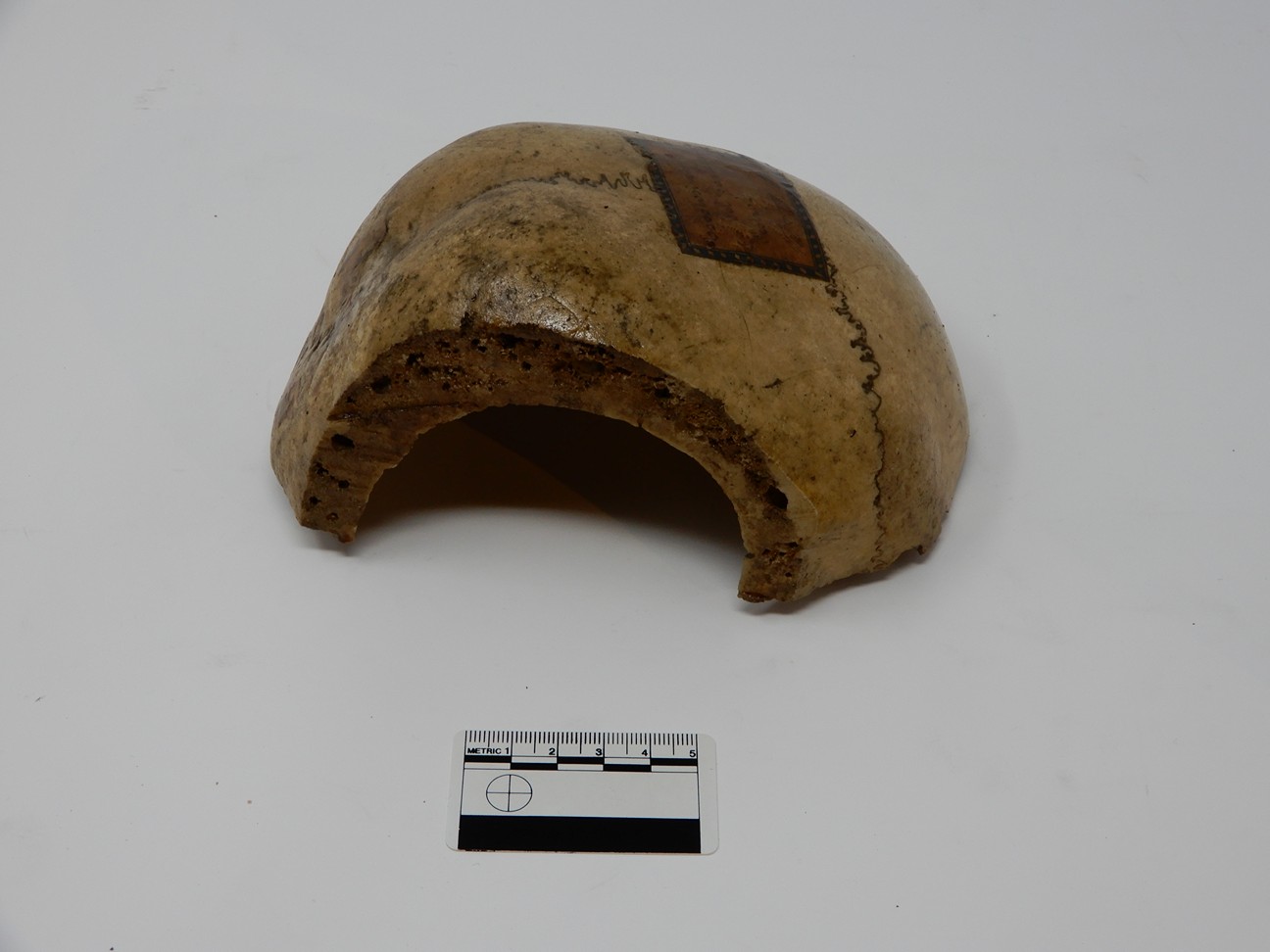 singolo reperto antropologico, reperto osseo (morfologia alterata per patologia) (XIX-XX)