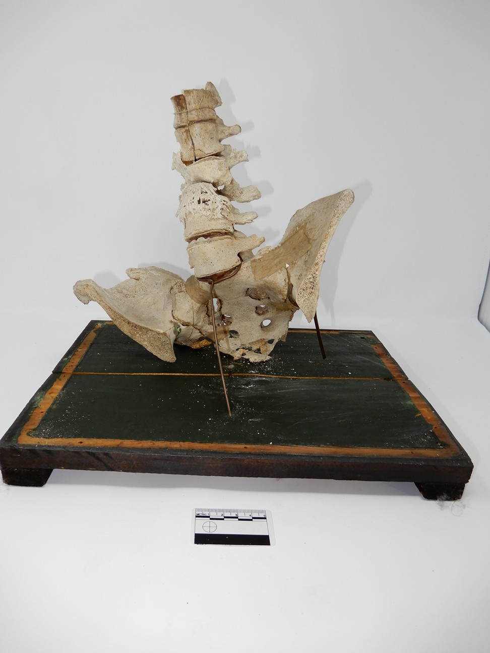 singolo reperto antropologico, reperto osseo (morfologia alterata per patologia) (XIX-XX)