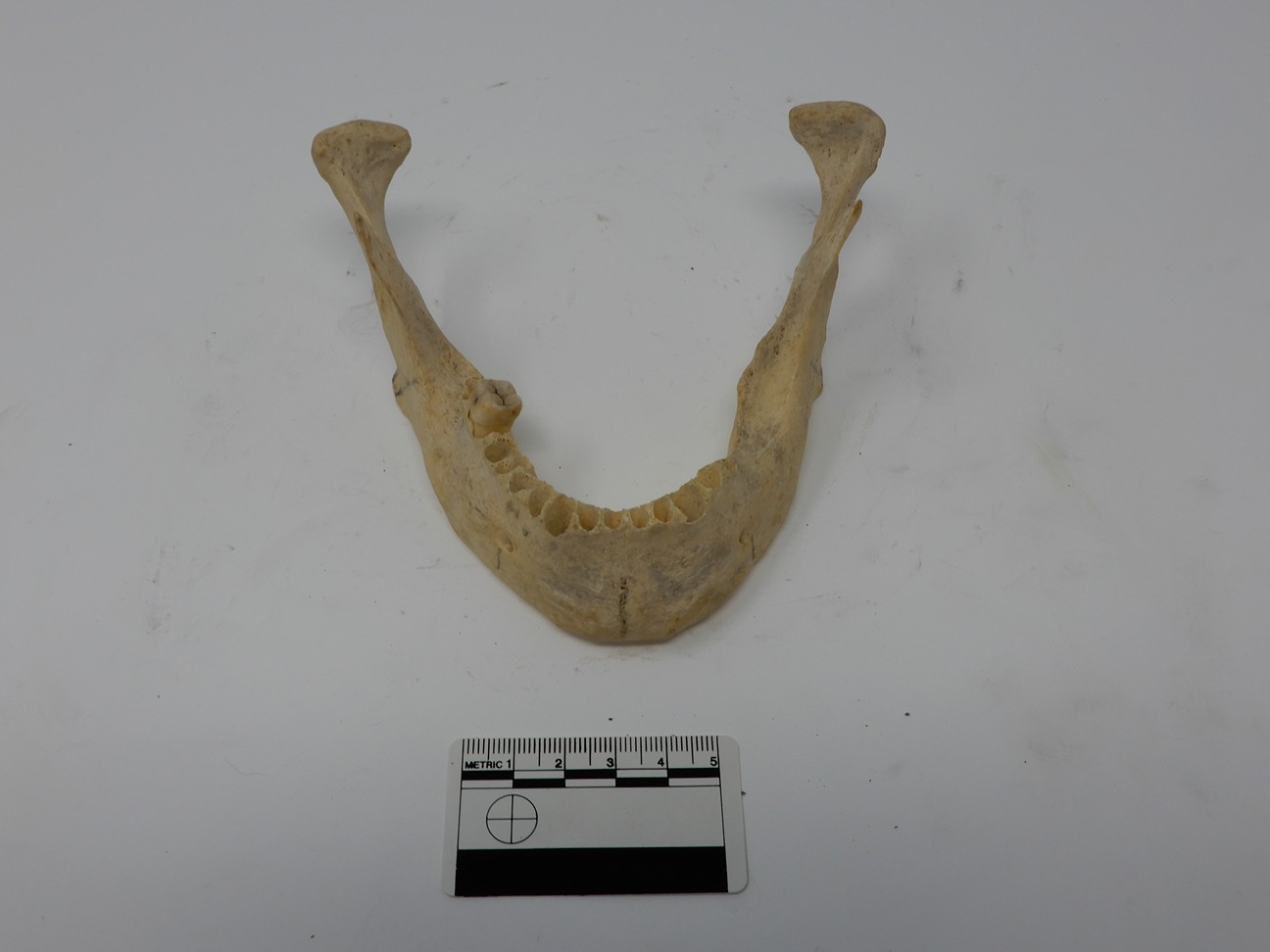 singolo reperto antropologico, reperto osseo (morfologia alterata per patologia) (XIX-XX)