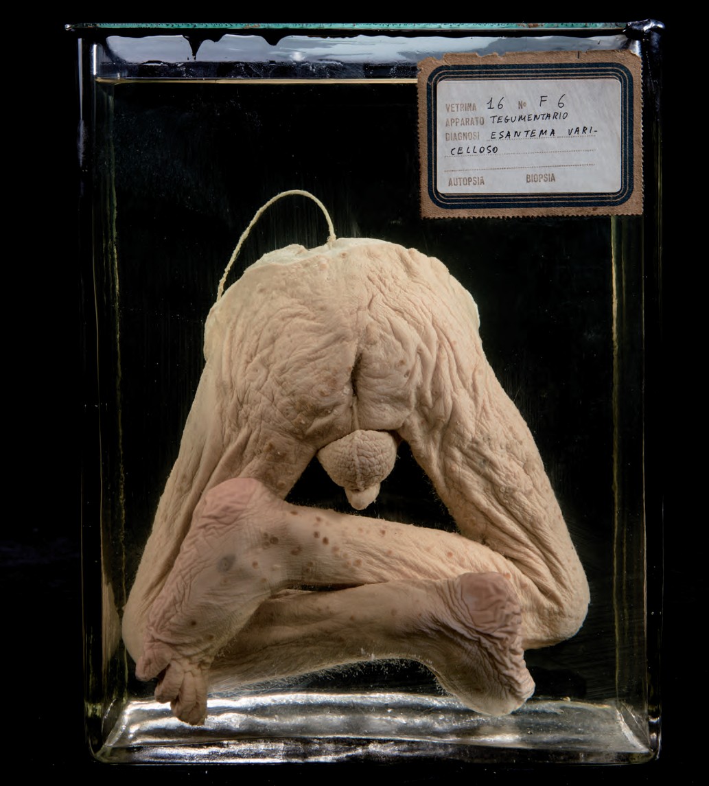 singolo reperto antropologico, preparato anatomico (morfologia alterata per patologia) (XIX-XX)