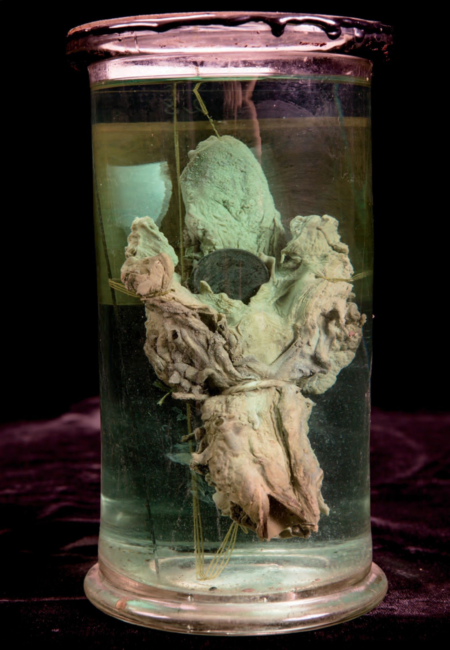 singolo reperto antropologico, preparato anatomico (morfologia alterata per patologia) (XIX-XX)