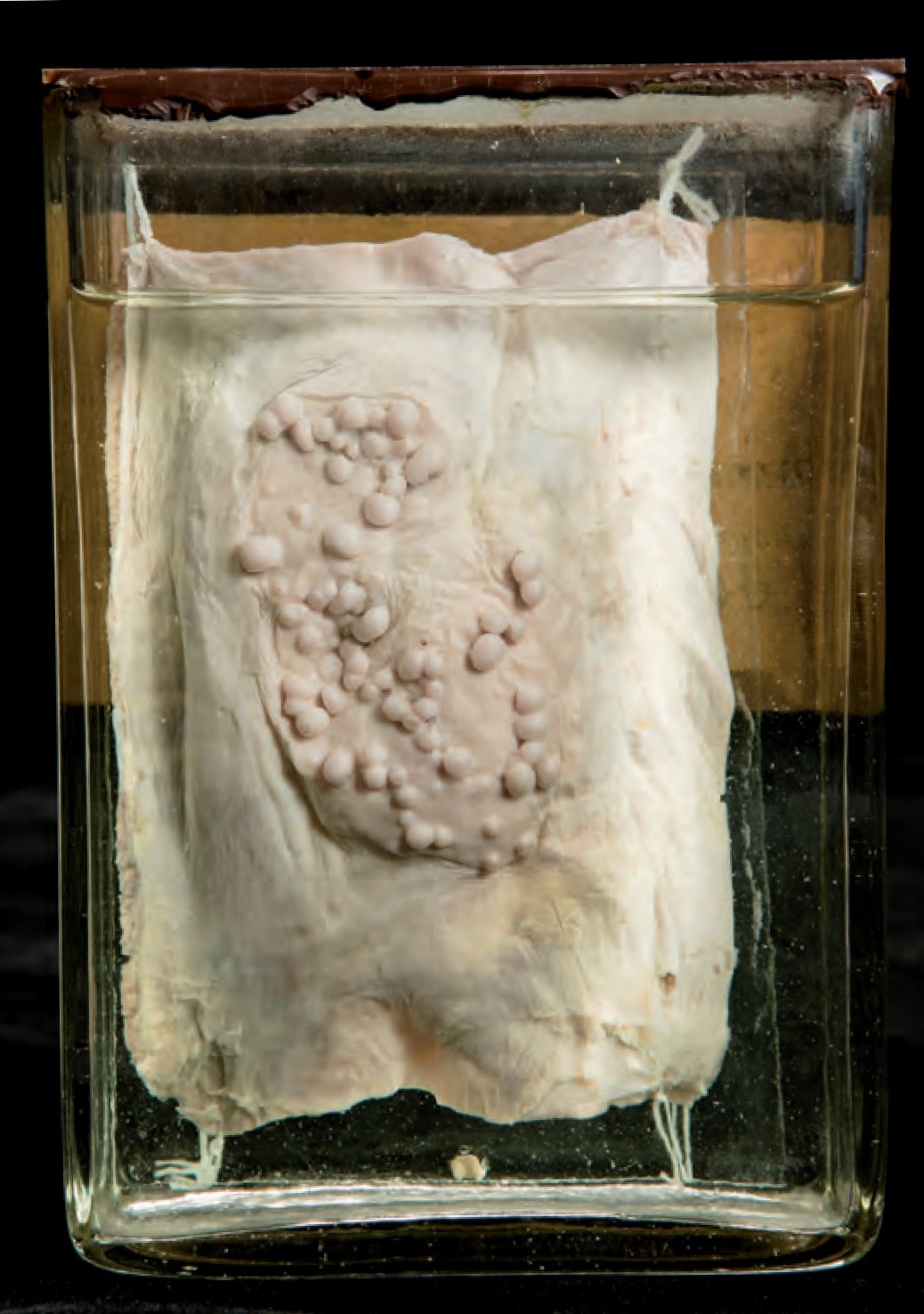 singolo reperto antropologico, preparato anatomico (morfologia alterata per patologia) (XIX-XX)