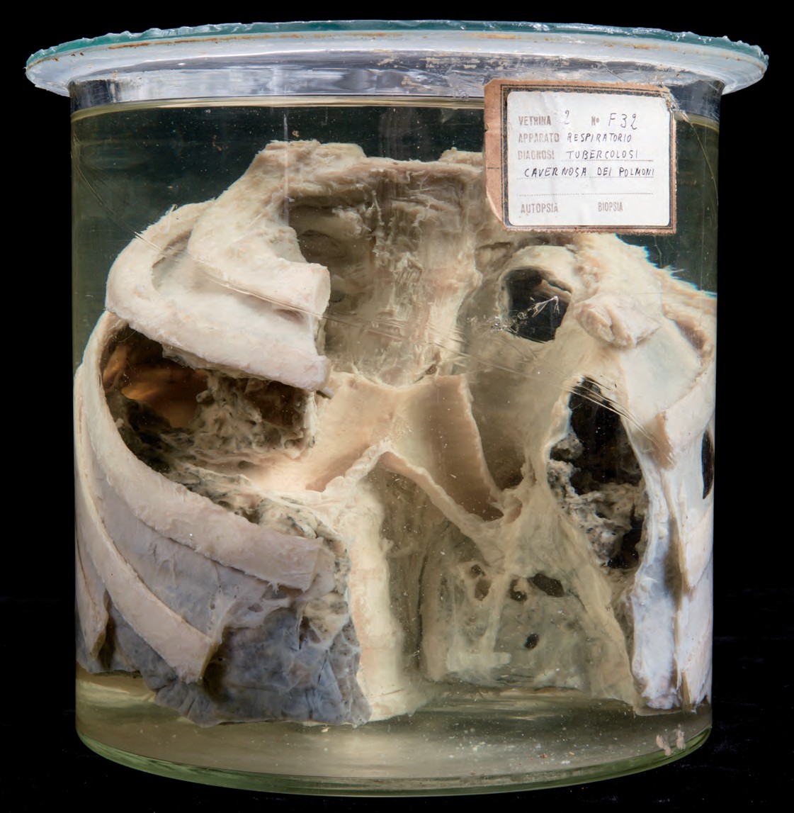 singolo reperto antropologico, preparato anatomico (morfologia alterata per patologia) (XIX-XX)