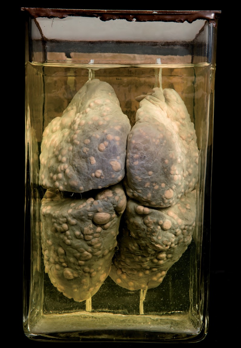 singolo reperto antropologico, preparato anatomico (morfologia alterata per patologia) (XIX-XX)