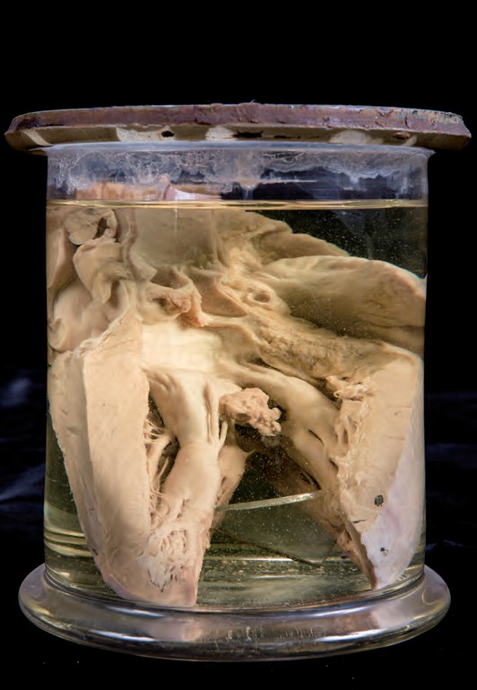 singolo reperto antropologico, preparato anatomico (morfologia alterata per patologia) (XIX-XX)