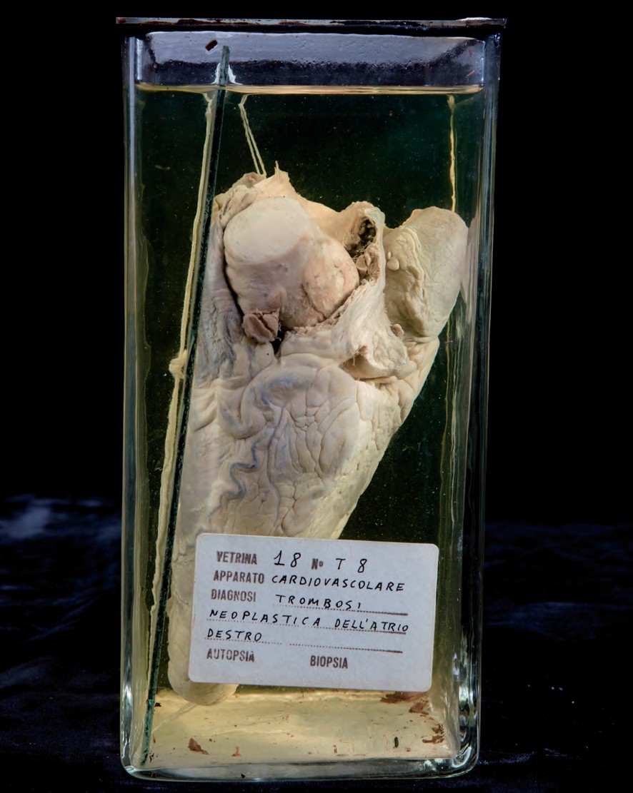 singolo reperto antropologico, preparato anatomico (morfologia alterata per patologia) (XIX-XX)