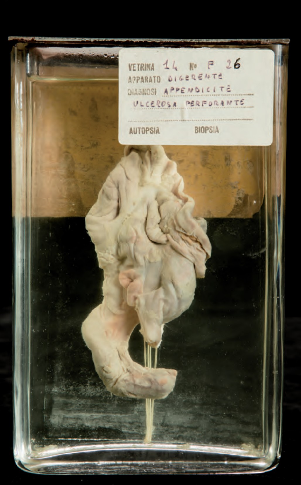 singolo reperto antropologico, preparato anatomico (morfologia alterata per patologia) (XIX-XX)