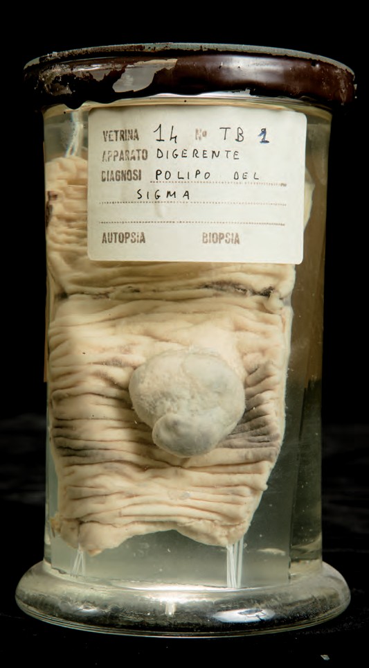 singolo reperto antropologico, preparato anatomico (morfologia alterata per patologia) (XIX-XX)