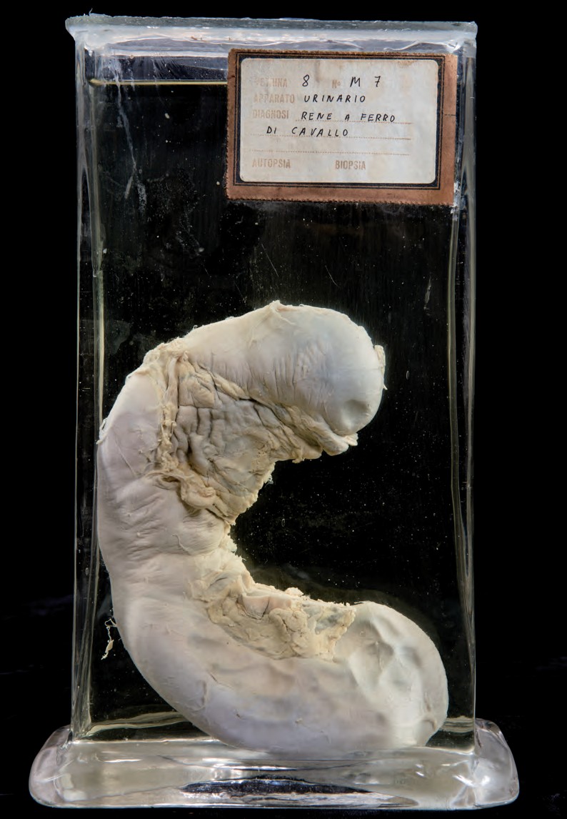 singolo reperto antropologico, preparato anatomico (morfologia alterata per patologia) (XIX-XX)