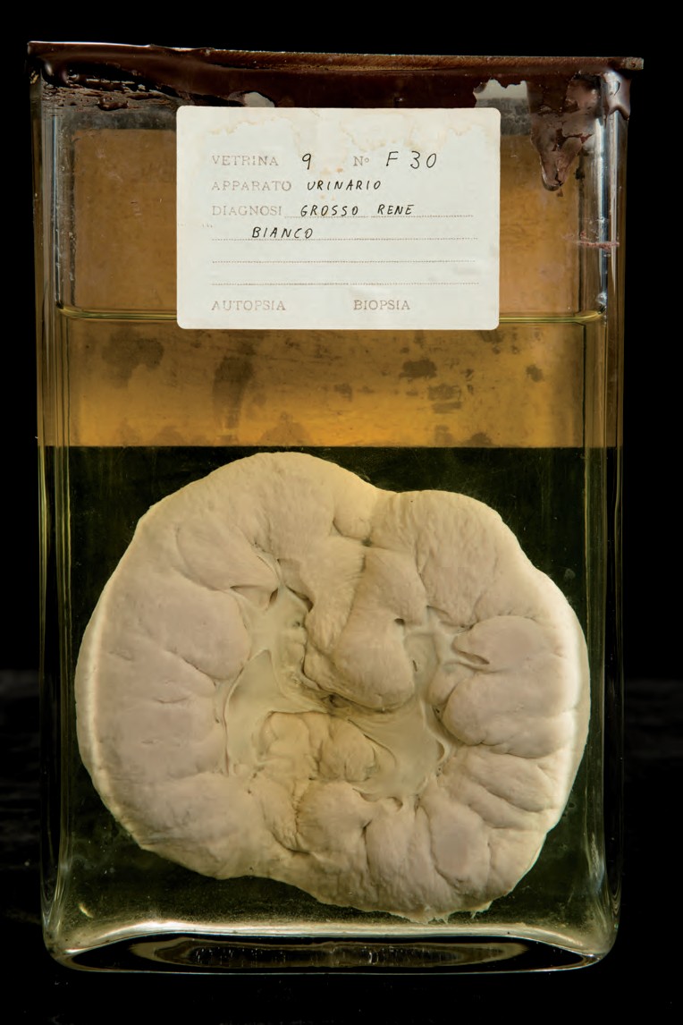 singolo reperto antropologico, preparato anatomico (morfologia alterata per patologia) (XIX-XX)