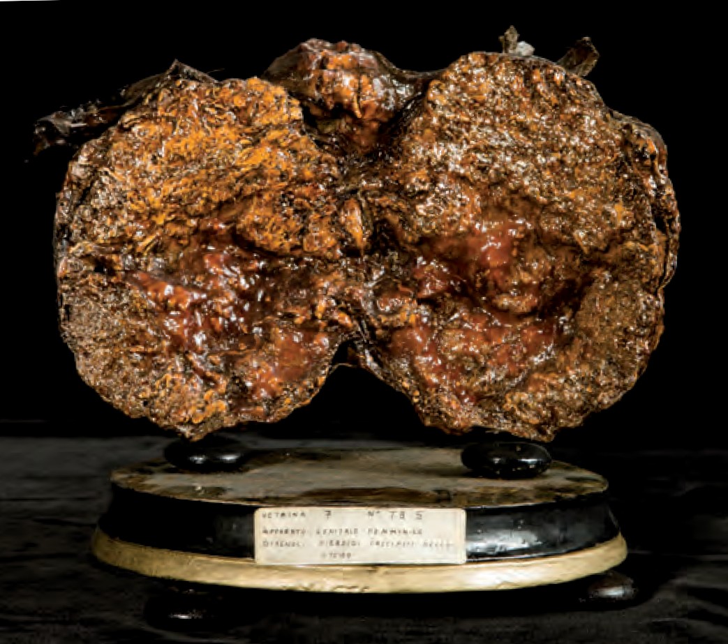 singolo reperto antropologico, preparato anatomico (morfologia alterata per patologia) (XIX-XX)