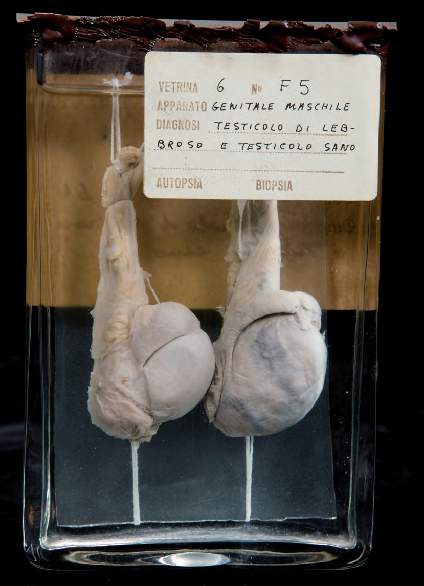 singolo reperto antropologico, preparato anatomico (morfologia alterata per patologia) (XIX-XX)