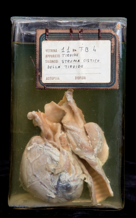 singolo reperto antropologico, reperto osseo (morfologia alterata per patologia) (XIX-XX)