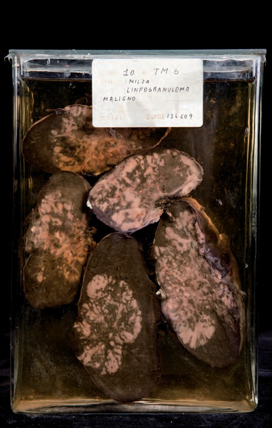 singolo reperto antropologico, preparato anatomico (morfologia alterata per patologia) (XIX-XX)