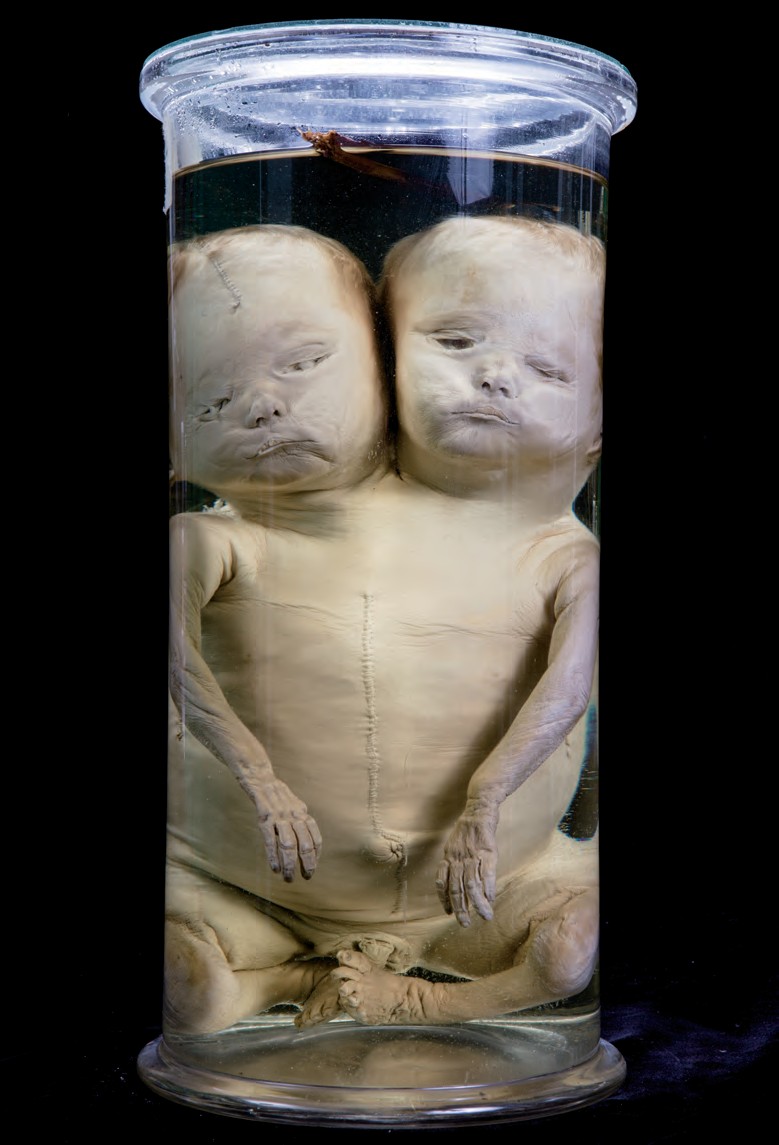 singolo reperto antropologico, preparato anatomico (morfologia alterata per patologia) (XIX-XX)