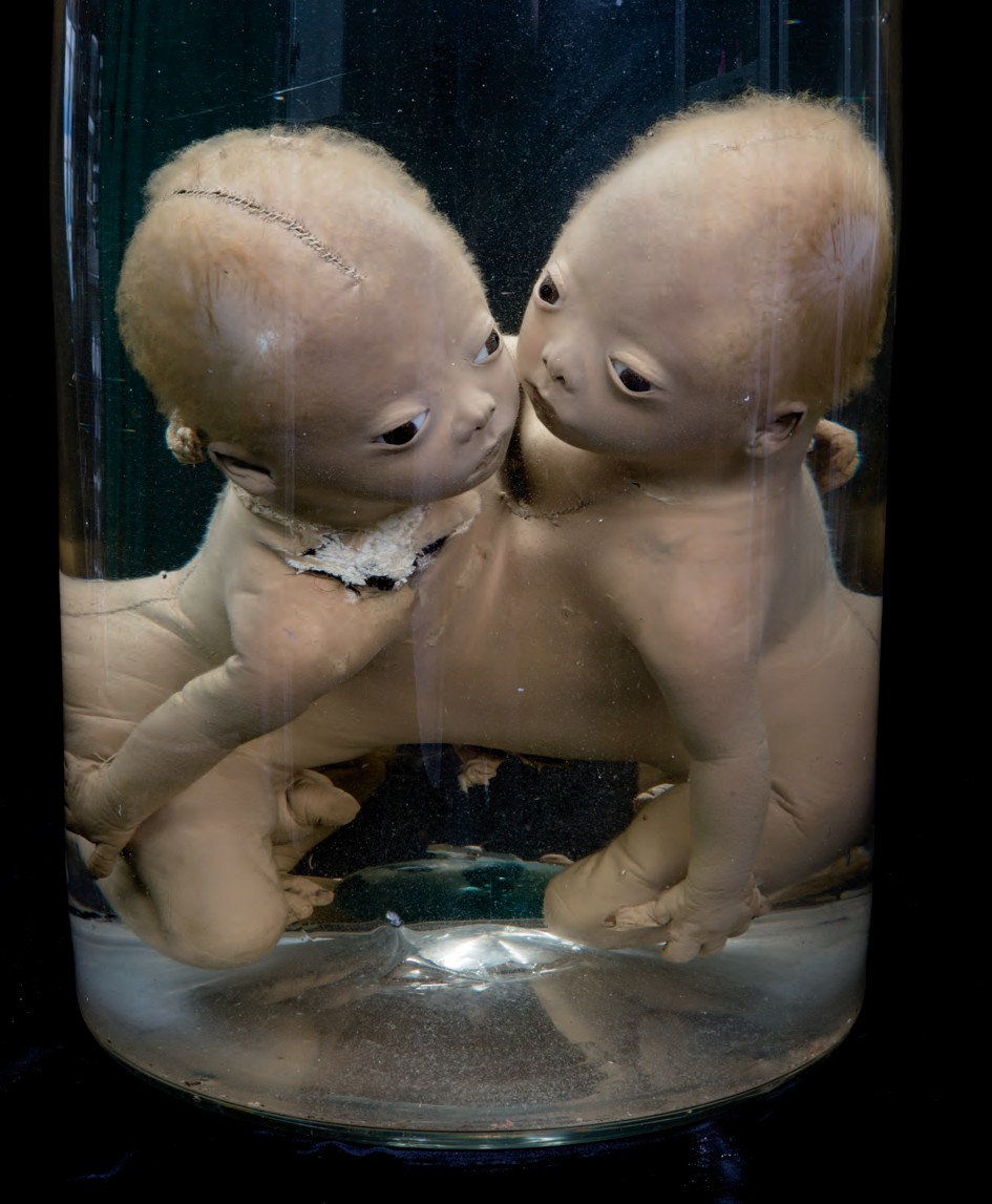 singolo reperto antropologico, preparato anatomico (morfologia alterata per patologia) (XIX-XX)