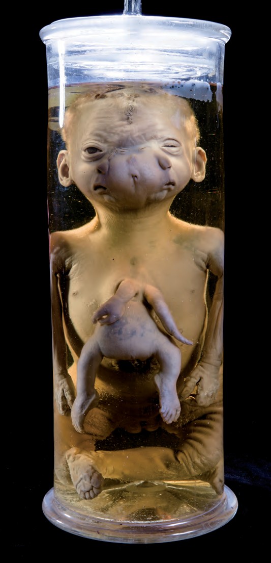 singolo reperto antropologico, preparato anatomico (morfologia alterata per patologia) (XIX-XX)