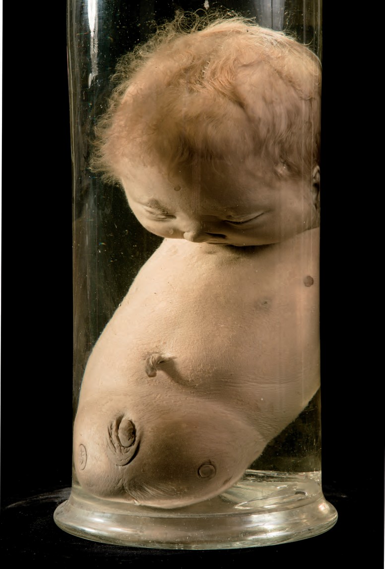 singolo reperto antropologico, preparato anatomico (morfologia alterata per patologia) (XIX-XX)