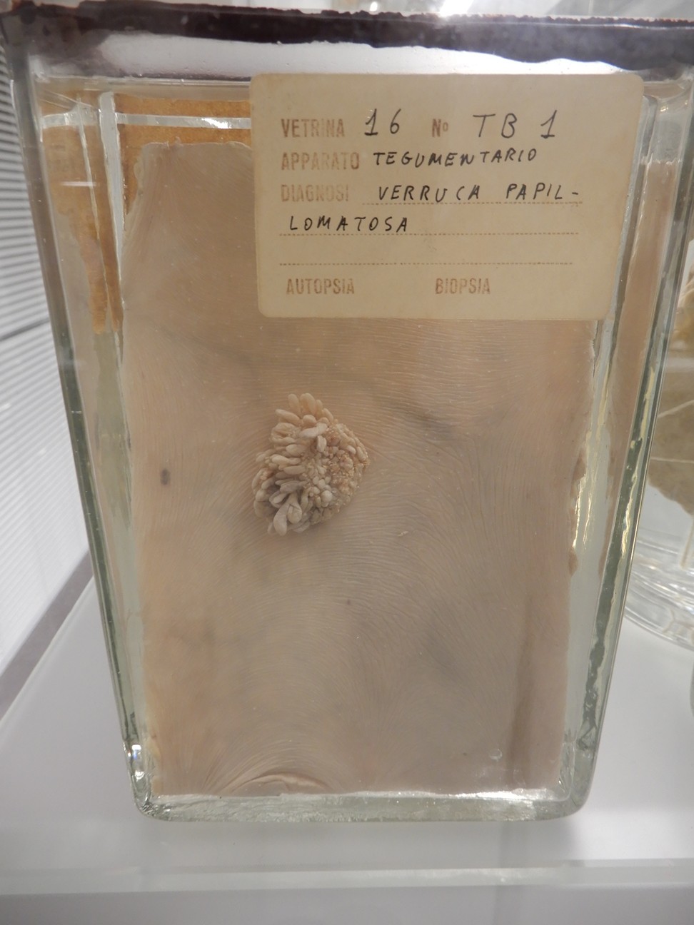 singolo reperto antropologico, preparato anatomico (morfologia alterata per patologia) (XIX-XX)