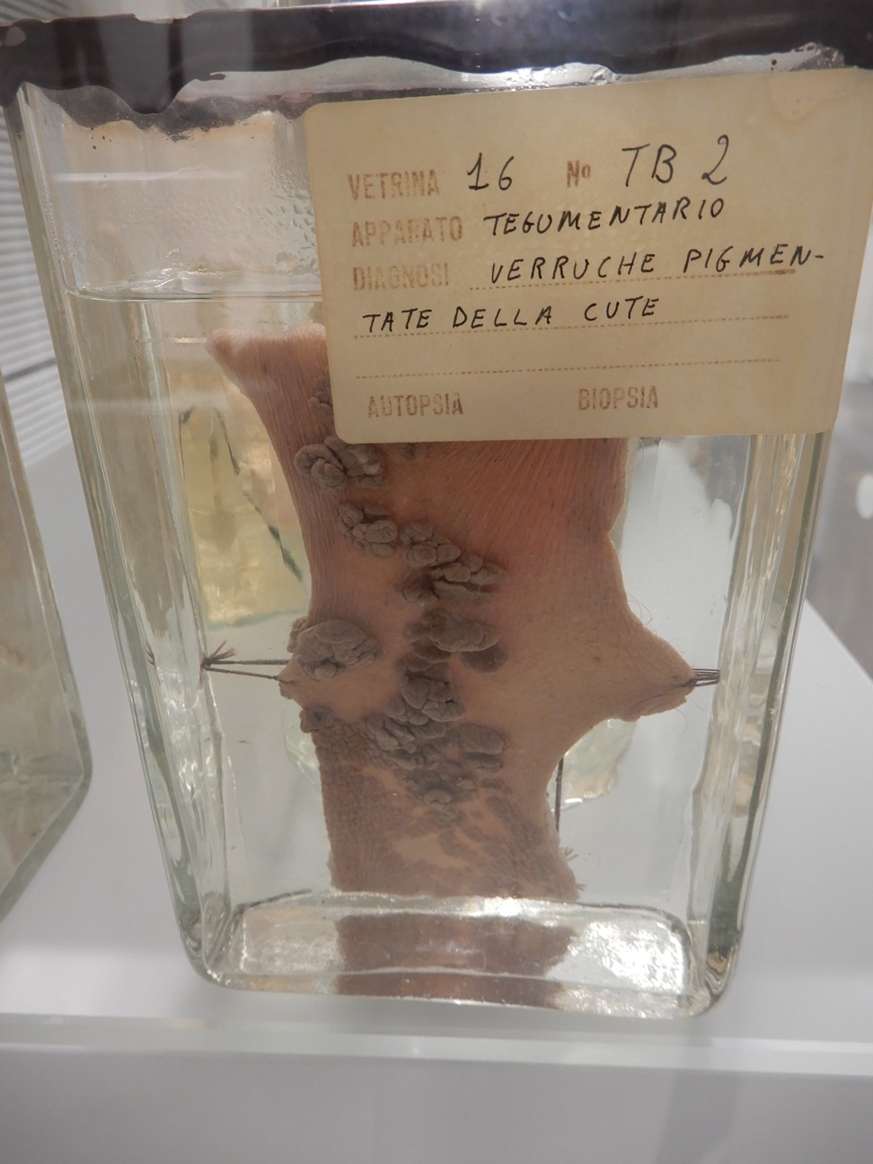 singolo reperto antropologico, preparato anatomico (morfologia alterata per patologia) (XIX-XX)