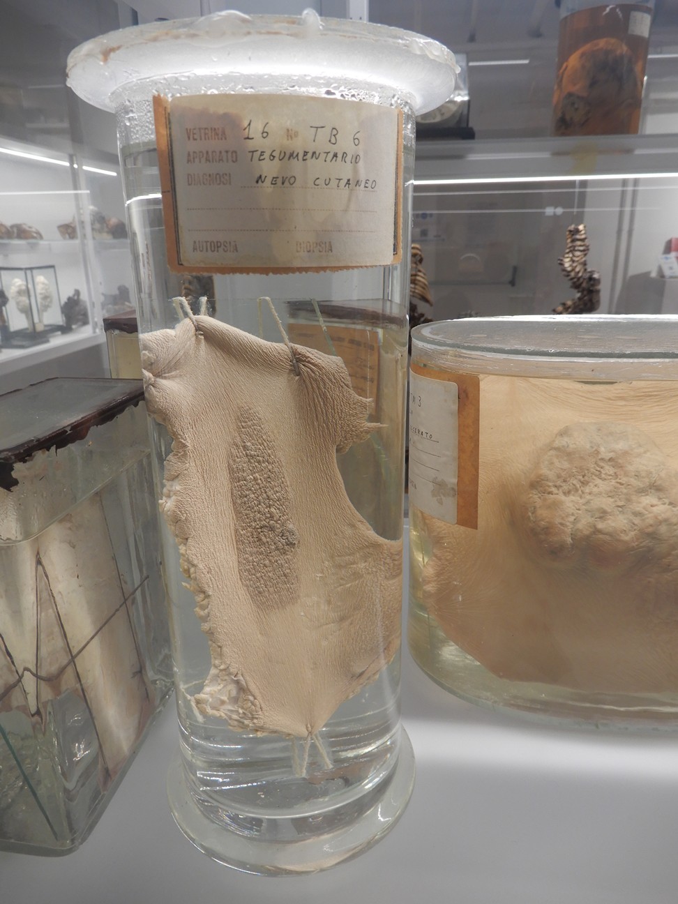 singolo reperto antropologico, preparato anatomico (morfologia alterata per patologia) (XIX-XX)