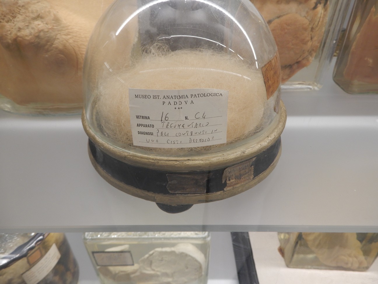 singolo reperto antropologico, preparato anatomico (morfologia alterata per patologia) (XIX-XX)