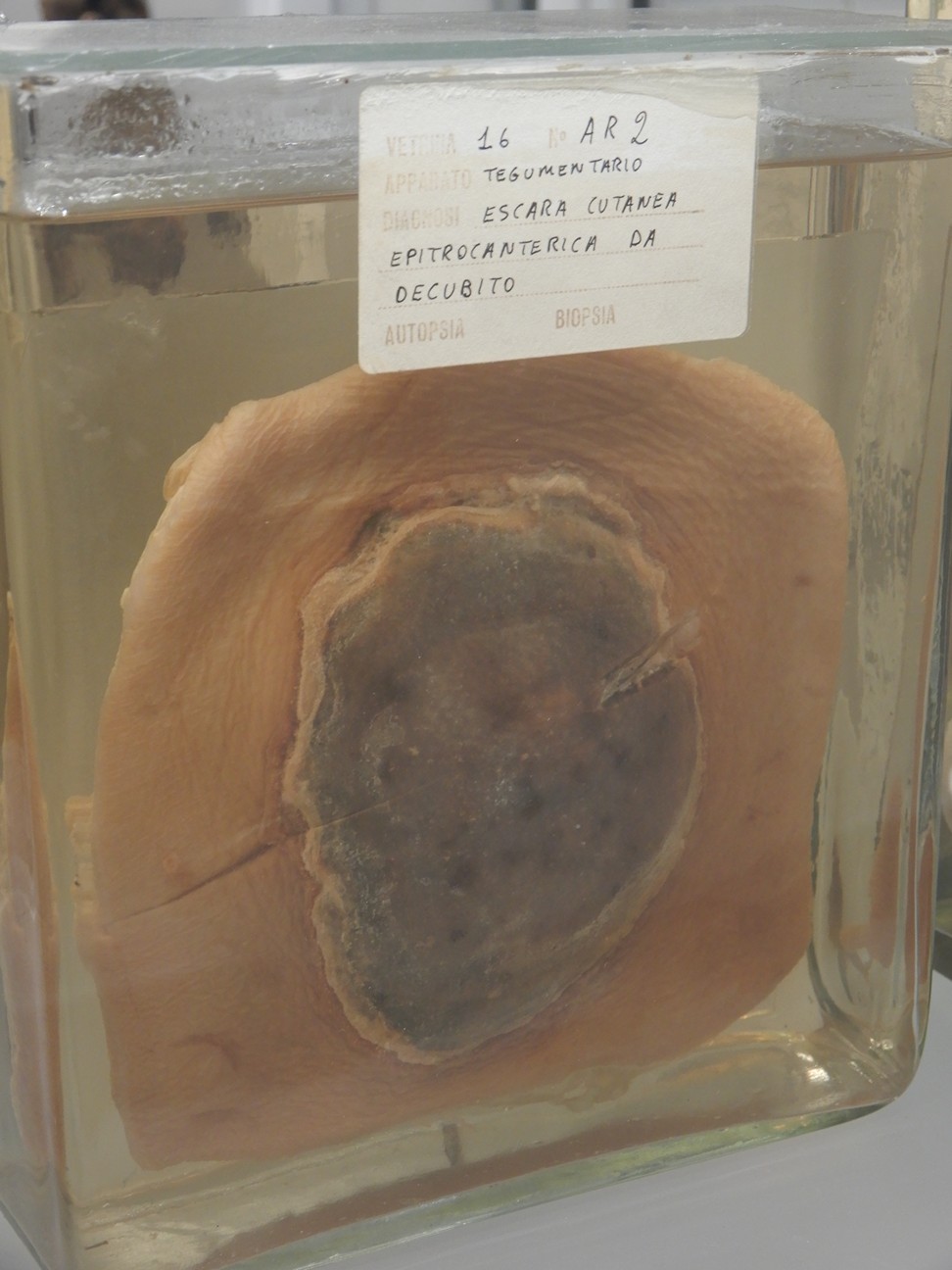 singolo reperto antropologico, preparato anatomico (morfologia alterata per patologia) (XIX-XX)