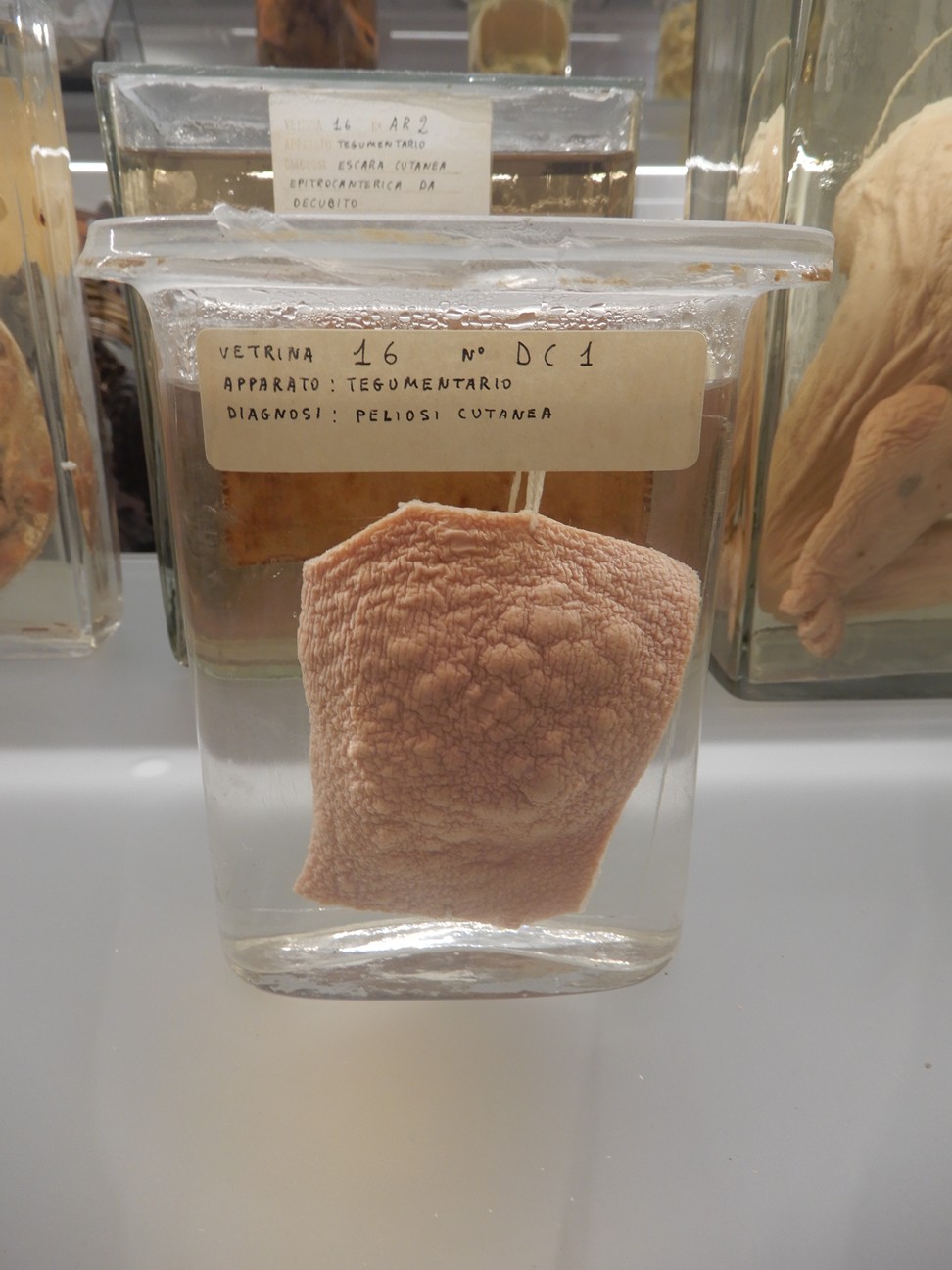 singolo reperto antropologico, preparato anatomico (morfologia alterata per patologia) (XIX-XX)